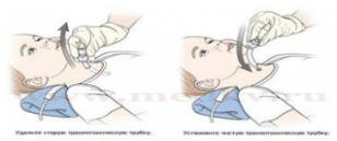 Смена трахеостомической трубки у ребенка