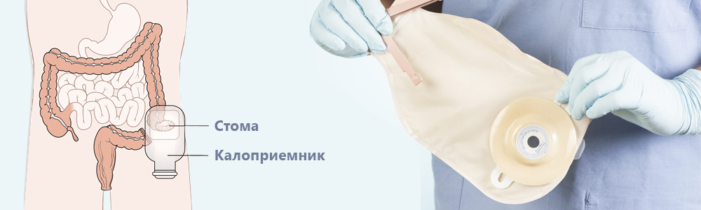 Установка калоприемников