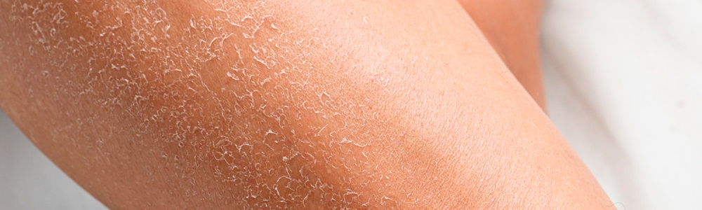 Последствия ухудшения кожного покрова после использования хлоргексидина Последствия ухудшения кожного покрова после использования хлоргексидина