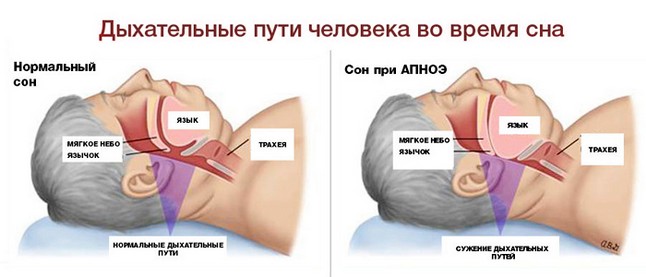 Что такое апноэ, его симптомы и причины